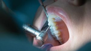 Endodoncia: Tratamiento y soluciones